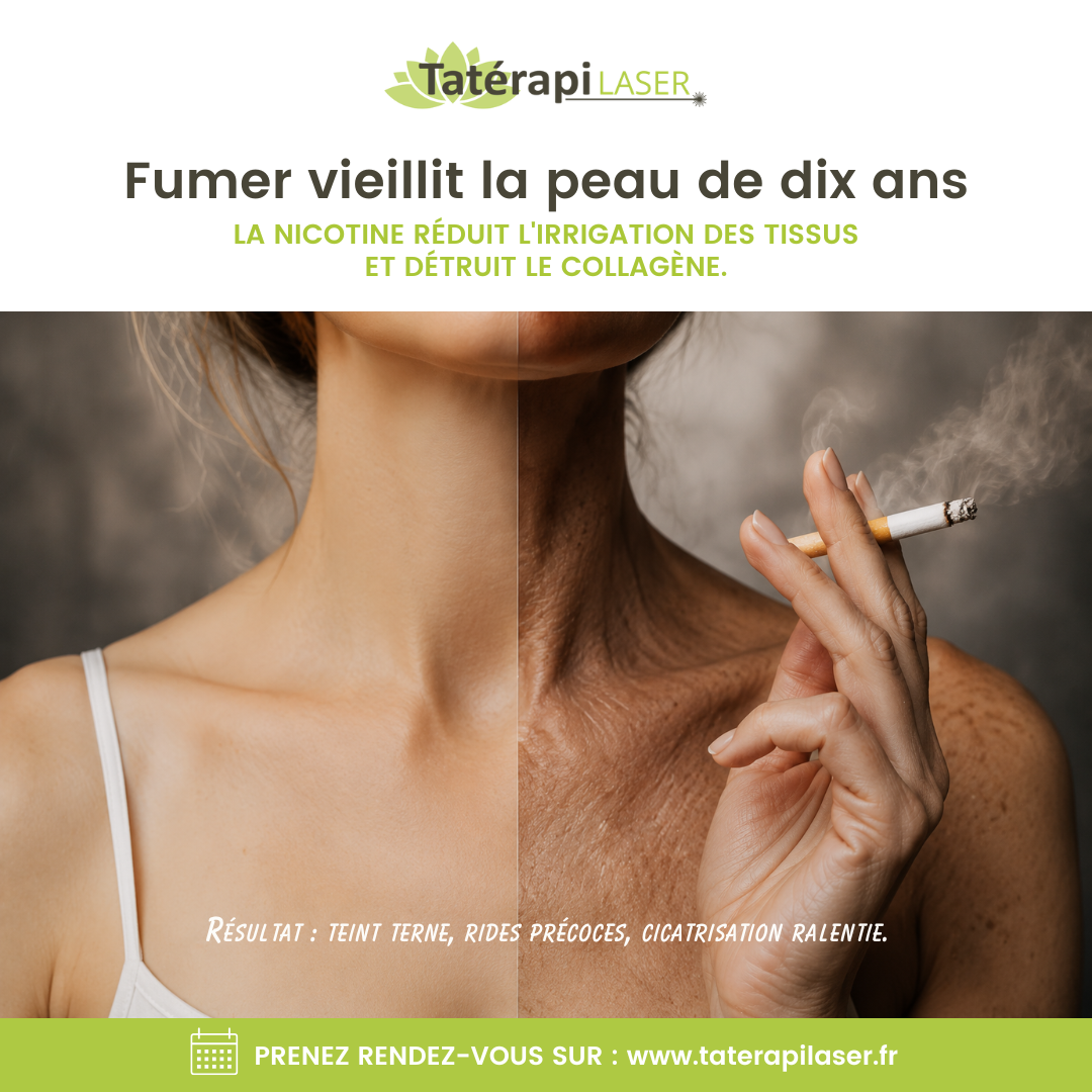 Tatérapi Laser Laval